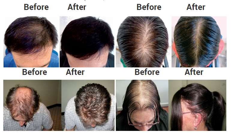 650nm Wavelength Hair Growth Helmet LLLT Laser Cap For Hair Loss