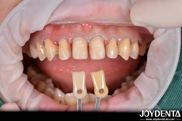 Finition dentaire composite durable Bonne biocompatibilité Pas de goutte de finition de porcelaine
