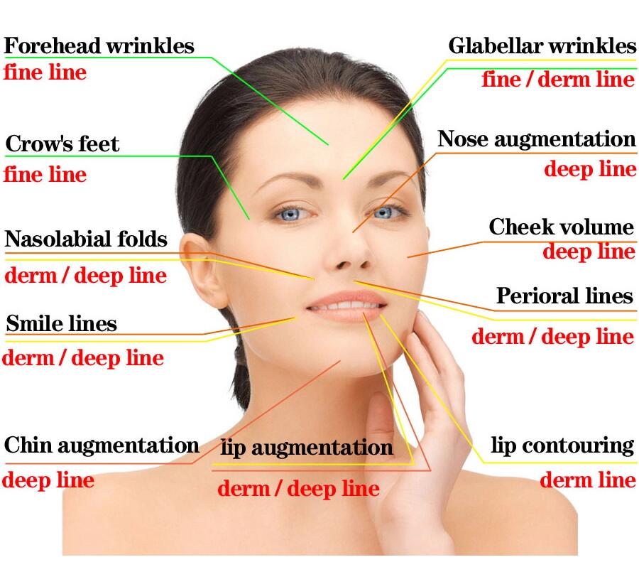 продолжительное шприца 1ml 2ml Hyaluronic кисловочное вводимое для глубоких морщинок