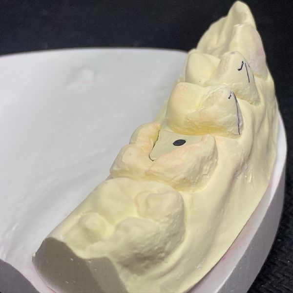 Reinforce Your Restoration with Lock Pink Post Core Technology