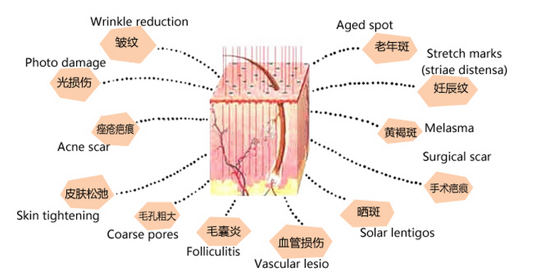 Best choice RF Metal Tube Acne scar removal Fractional Co2 Laser Machine
