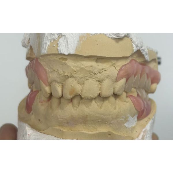 Removable Denture with Lingual Bar Retention for High Precision Fit and Conservative Tooth Preservation