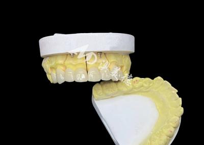 Obtenha um sorriso perfeito com coroas dentárias de cerâmica de alta qualidade para aparência natural e resistência duradoura