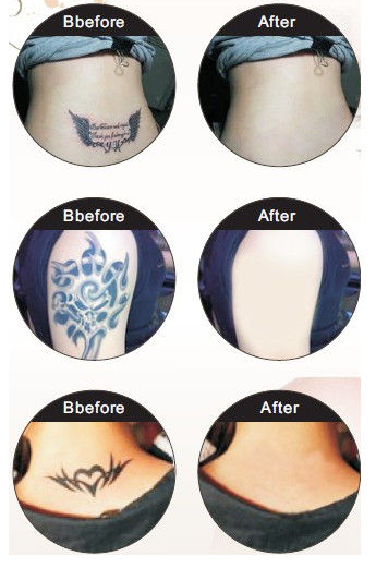 Portable Q - Switch Back ND YAG Laser Tattoo Removal Machine 1064 nm / 532 nm