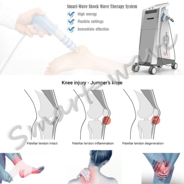 Extracorporeal Smartwave ESWT Shockwave Therapy Machine For Heel Pain , Plantar Fasciitis