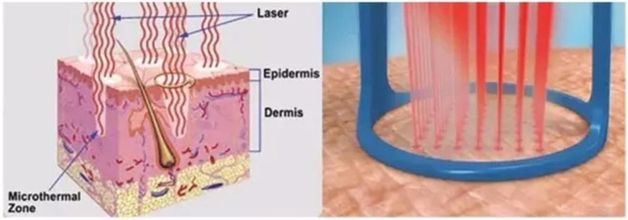 40W Fractional Vaginal Rejuvenation Machine Facial Whitening 10600nm Wavelength