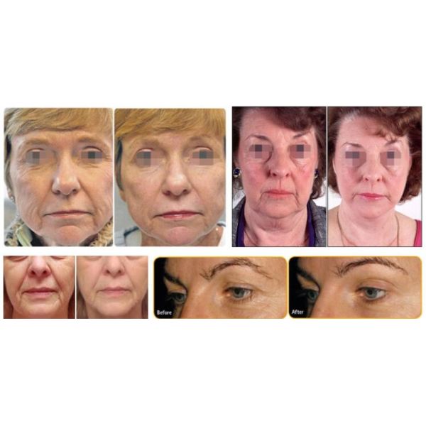 2016 High-Intensity Focused Ultrasound ultrasonic skin tightening wrinkle removal HIFU Machine