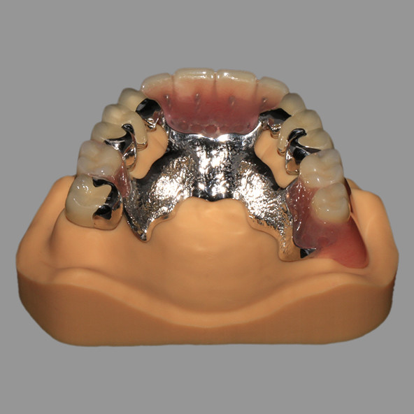 CoCr Acrylic Cast Metal Partial Combined With Fixed PFM