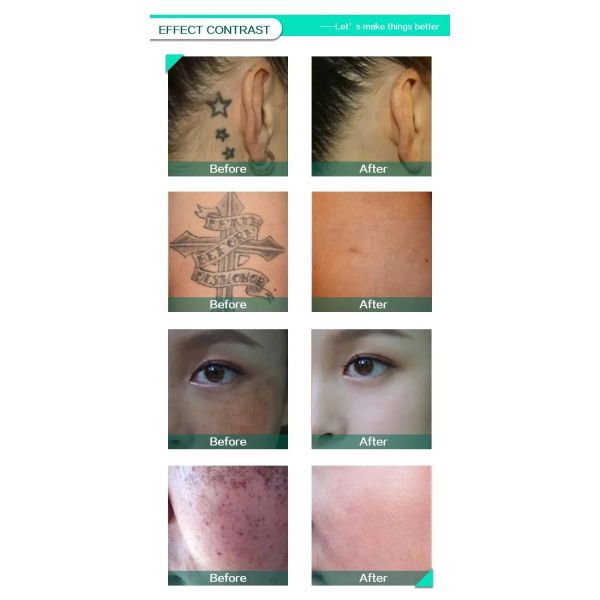 2 в 1 пикосекундный лазер с 360 магнитной IPL удаления волос машины