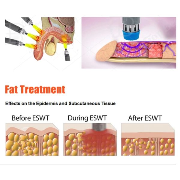 Сало машины ударной волны физиотерапии Cryolipolysis уменьшает внекорпусное