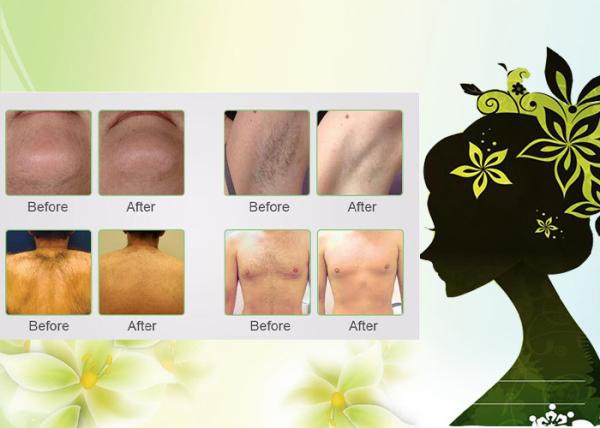 Laser diode 808 hair removal machine with permanent results