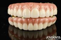 High Durability Ti-Bar Zirconia Hybrid Bridge For Achieving Aesthetics