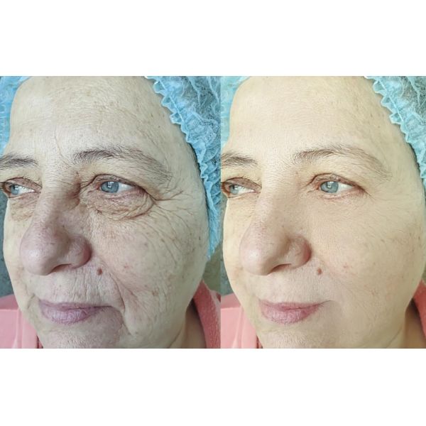 Точным форма соединенная крестом Skinject Hyaluronic кисловочная дермальная заполнителя геля 2ml