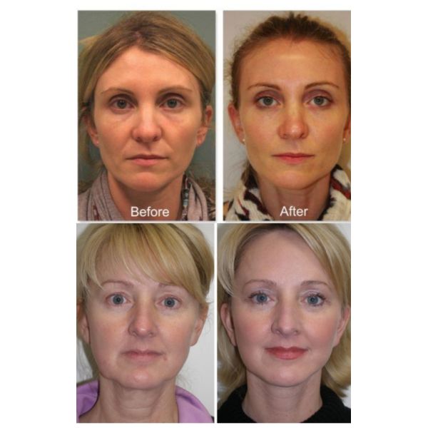 9-12 meses Solução de beleza para o rosto