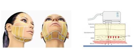 White Hifu Vaginal Tightening Equipment / Wrinkle Removal Machine 200w Power