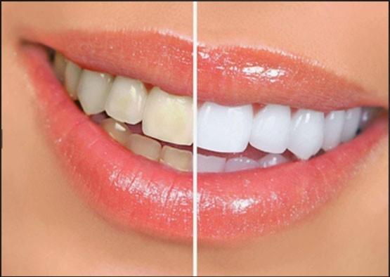 IPS 0.2mm Ultra Thin Emax Veneers Stain Resistant With High Strength