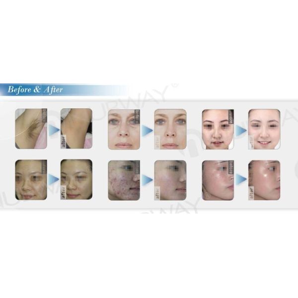 The most professional three multifunctional handles ipl power supply