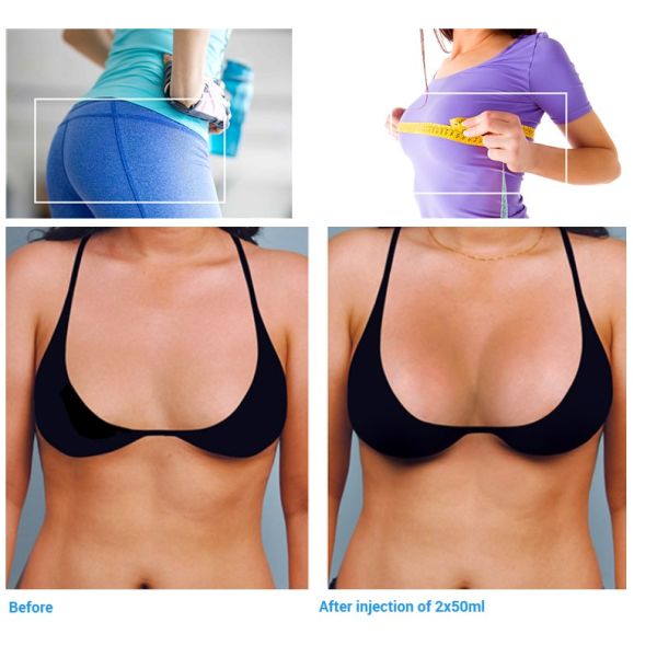 Впрыски груди заполнителя груди Skinject Hyaluronic кисловочные Hyaluronic кисловочные