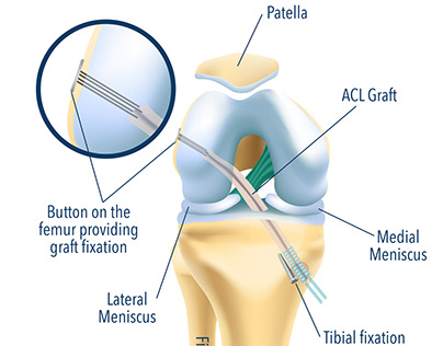 Титан 4*12mm Endobutton ACL протезных спорт медицинский