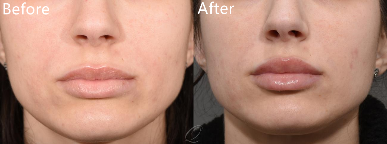 Повышение губы Juvederm 2x1ml заполнителя Ha впрыски извлекает морщинки