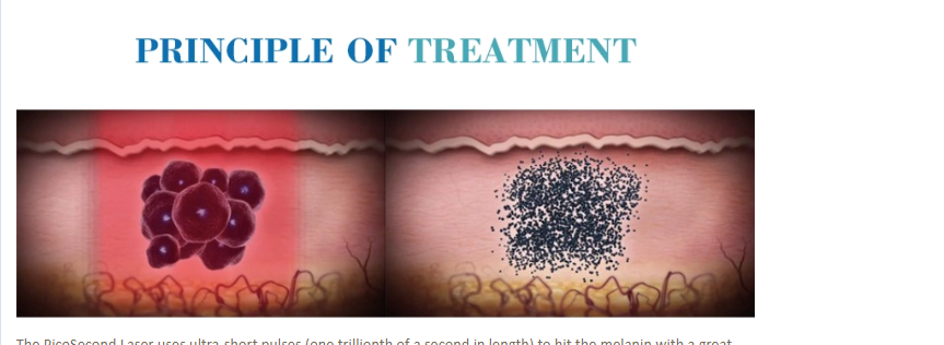 Nd Yag Laser beauty equipment Nubway pico laser tattoo removal machine picosure laser