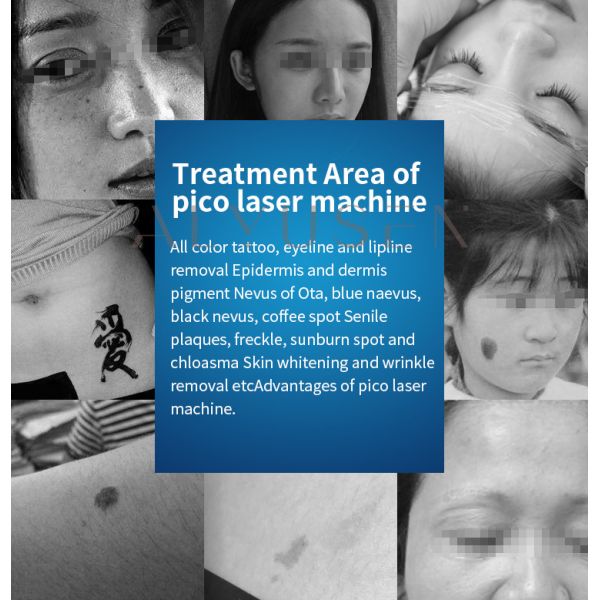 Q Switched Nd Yag Picosecond Laser Tattoo Removal Machine Skin Whitening