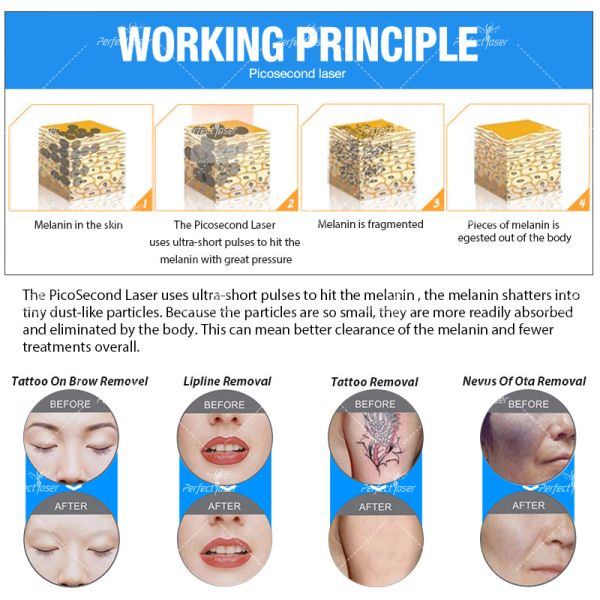 Машина Нд Яг 2500В удаления татуировки пикосекундного лазера воздушного водяного охлаждения