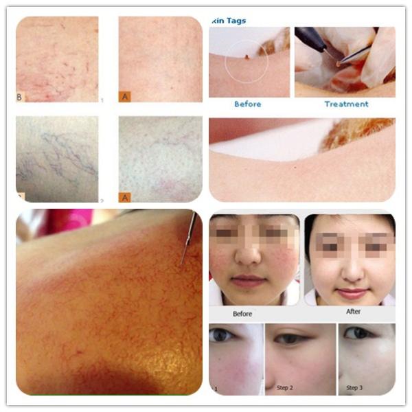 WHOLESALE PRICE Chinese beauty equipment distributer spider vein redness removal machine in promotion