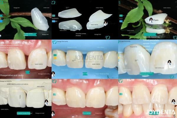 Ceramic For Natural Aesthetics Dental Veneers Stain Resistance Maintains Brightness Strong Bond With Tooth Enamel For Secure Fit