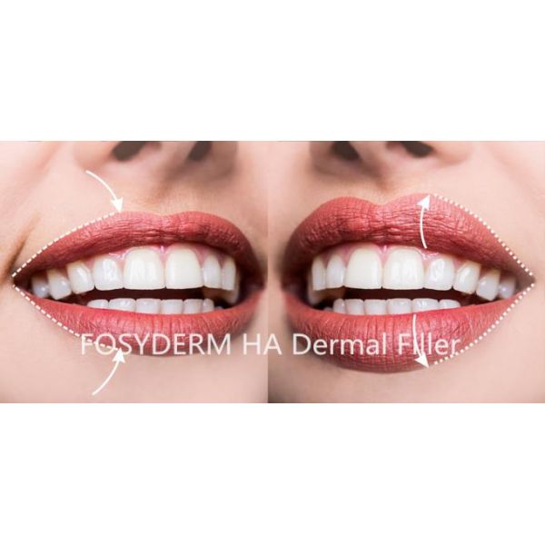 Месяцы продолжительности впрыски 6 до 18 геля заполнителя Хялуроник кислоты ОЭМ Одм лицевые