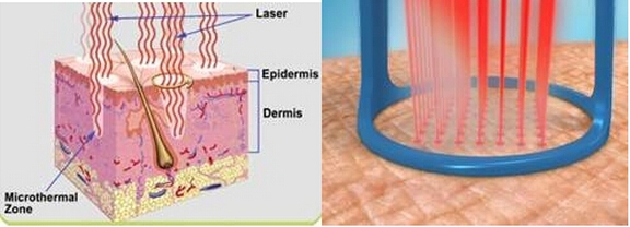 Co2 Fractional Laser Machine Wavelength 10600 nm Rated Power 800 Watt Net Weight 52 Kgs