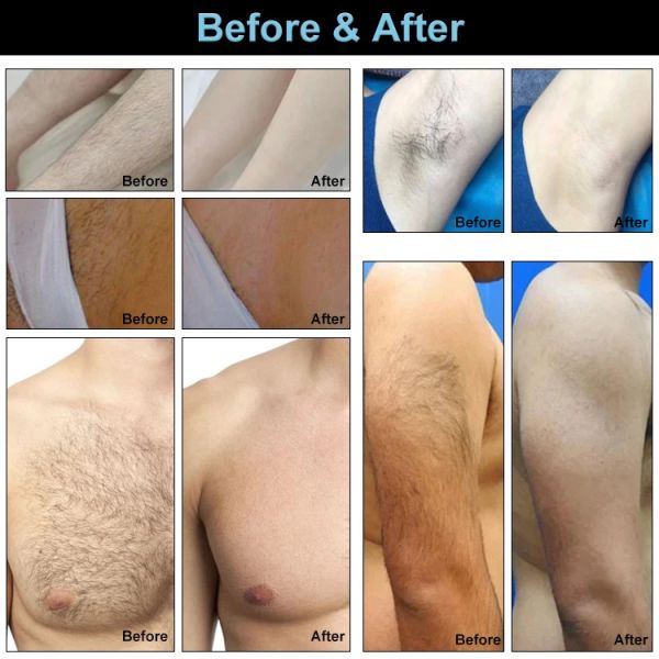 2In1 Nd Yag Pico épilation de tatouage haute puissance 1500W-3600W glace de platine 808Nm 808 Diode Laser épilation machine