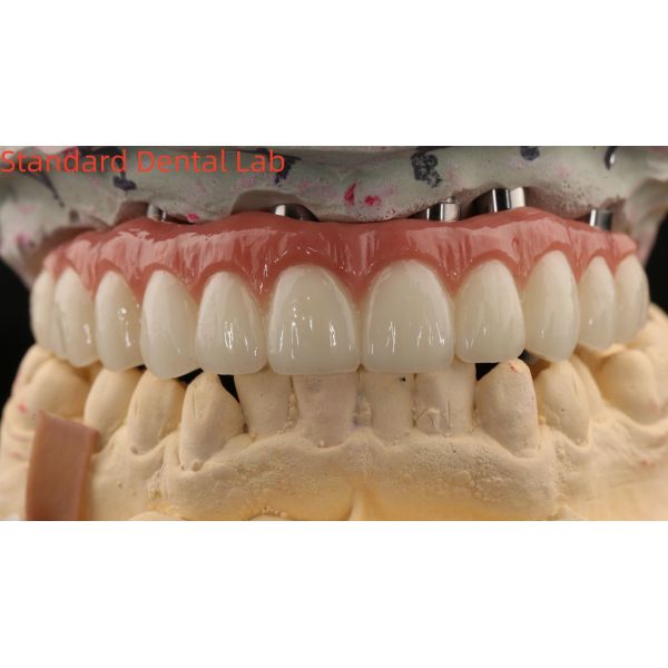Porcelain All On Four Zirconia Bridge High Esthetics Dental Implant Bridge Screw Retained