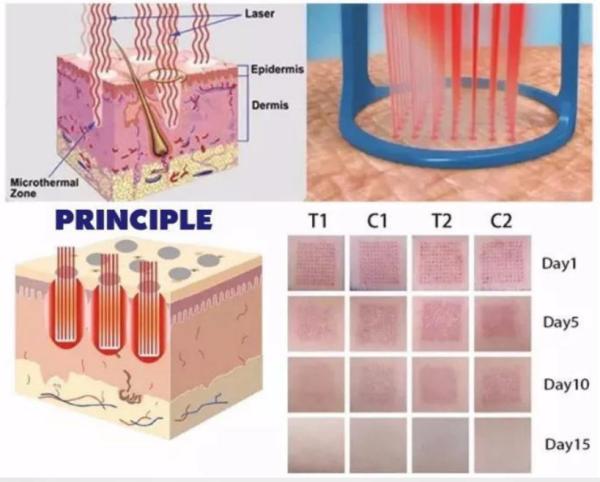 Máquina de Laser Fracionado de Rejuvenescimento da Pele/Restração Vaginal Profissional de C02