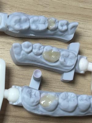 Dental Inlay Tooth Restoration with CAD/CAM Digital Technology High Fracture Resistance and Metal-Free