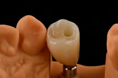Titanium Single Tooth Dental Implants Internal Hex Connection Type For Optimal Fit