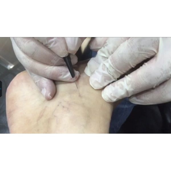 Factory Price Spider Vein Removal Machine / Veins Removal Machine / Facial Vein Removal