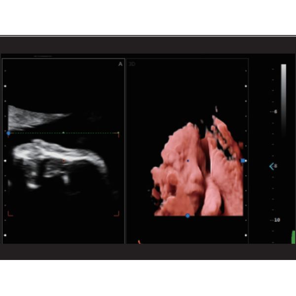 Fetal Doppler Medical Ultrasound Machine Trolley 3D 4D 5D