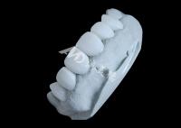 Coroa dental de zircônio que oferece força imbatível e suavidade natural, e translucidez natural.