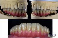 Dental Reconstruction Multiple Teeth Implant Titanium Prosthetic Connection Internal