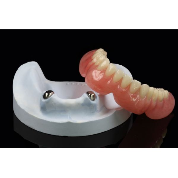 Telescope Removable Dentures Precision Attachment Overdenture Arylic