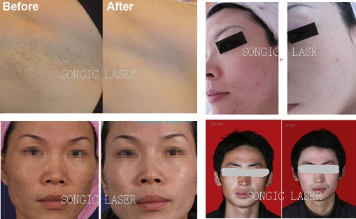 CE Approval Skin Whiteing IPL Hair Removal Machines For Women , IPL Beauty Equipment