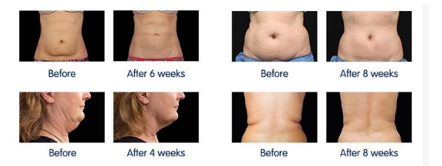 Ultrasound Hifu Face Lifting Machine 0.2 - 3.0J Energy Facial Massage Device