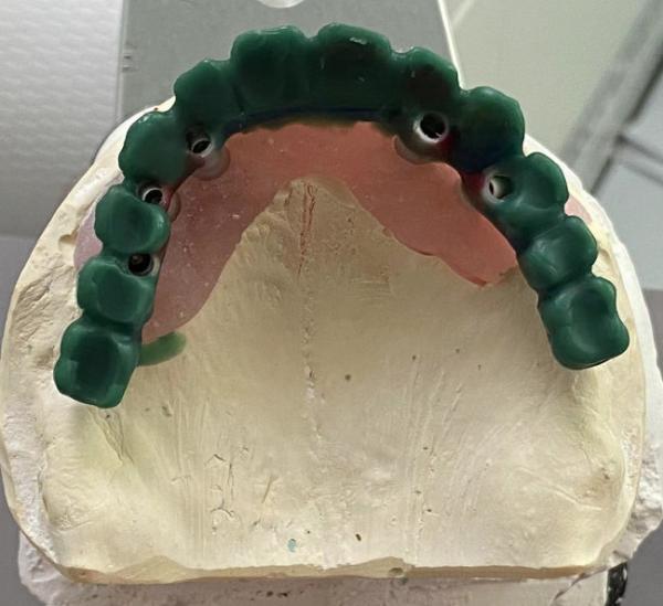 High Precision Implant Supported Crown Stable And Easy Maintenance