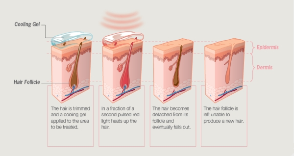 Многофункциональные 4 в 1 машине лазера НД Яг Элигхт ИПЛ РФ удаления волос удаления татуировки