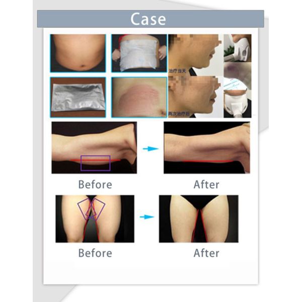 LF-218 portable cryo slimming machine / cryo for fat reduction / cryo slimming device