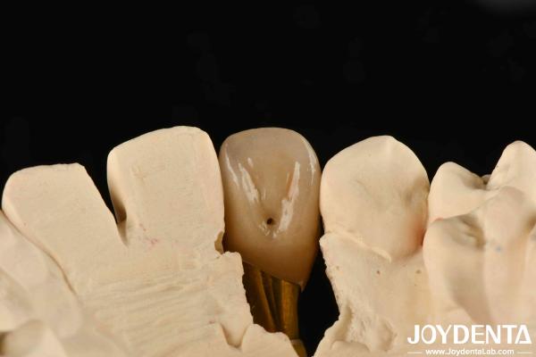 0° Angulation Finished Dental Abutments 1.5mm Thread Pitch Polished Surface
