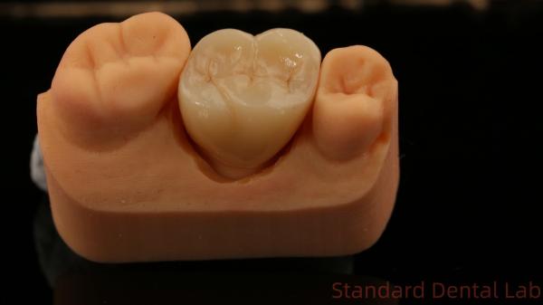Mill and Centring Full Zirconia Crown , China Dental Lab Fast Delivery