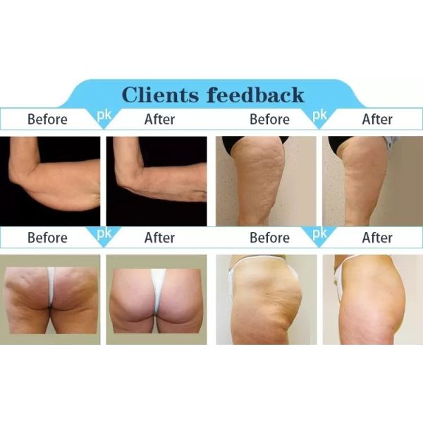 Best Multifunction 3D Lipo Body Shape Ultrasonic RF Vacuum Cavitation Face Lifting Slimming RF Skin Tightening Machine