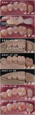 Seamless Fit Porcelain Inlay Dental Procedure Customizable Shape For Teeth Repair